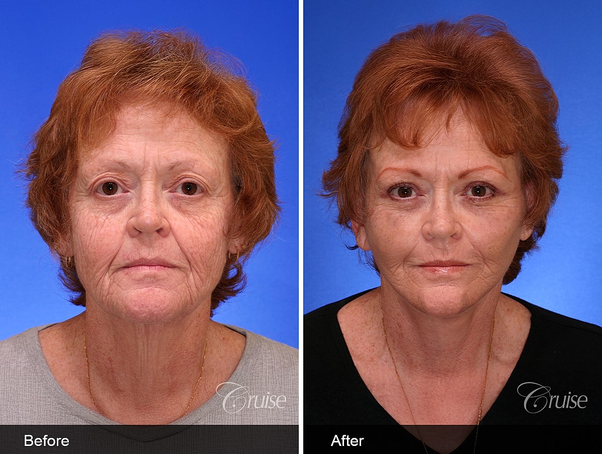 Face Lift Before & After