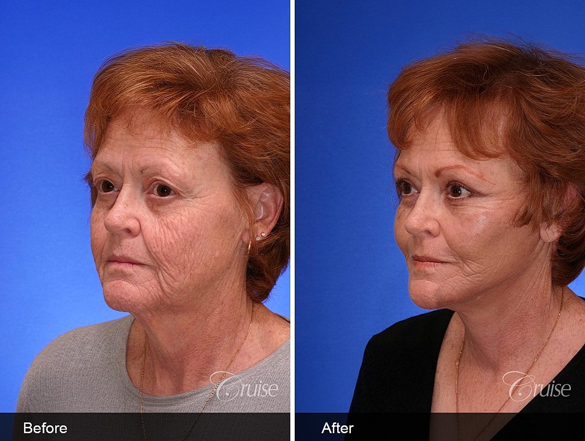 Face Lift Before & After
