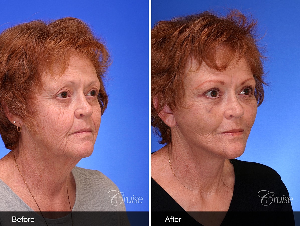Face Lift Before & After