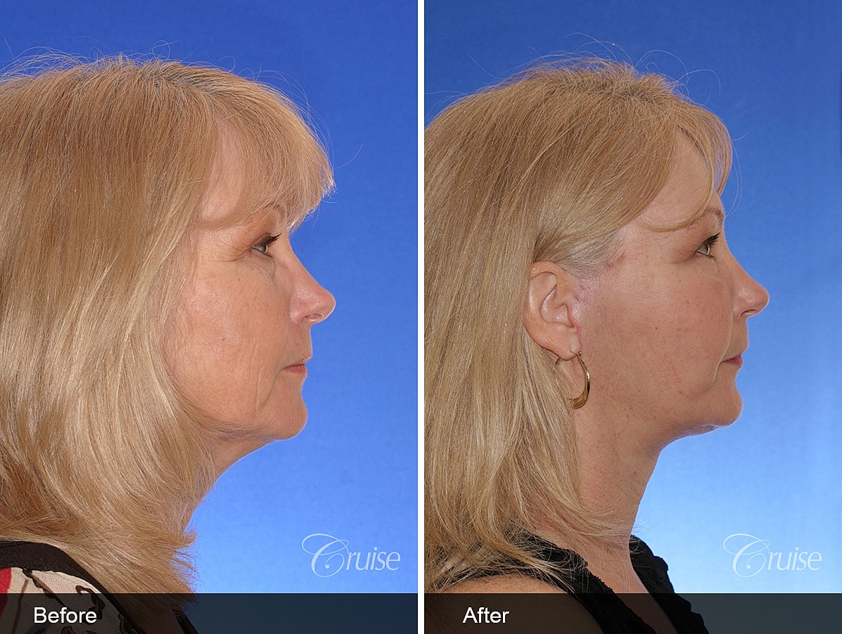 Face Lift Before & After