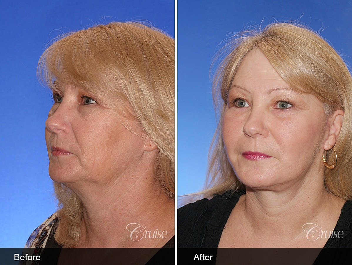 Face Lift Before & After