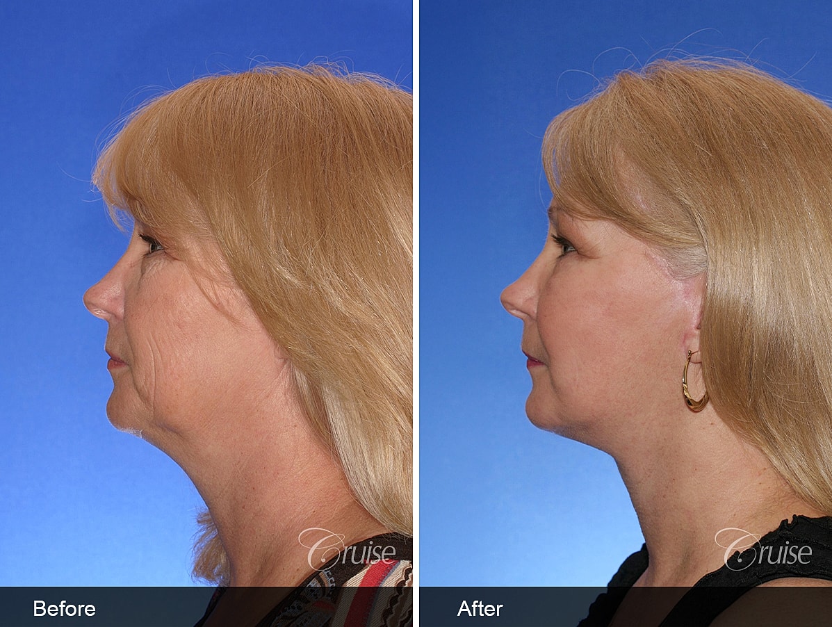 Face Lift Before & After