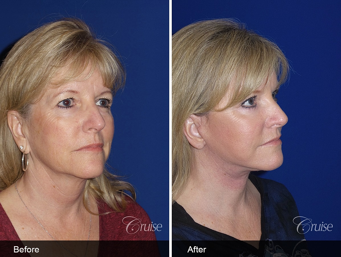 Face Lift Before & After