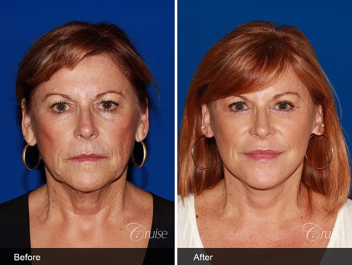 Face Lift Before & After