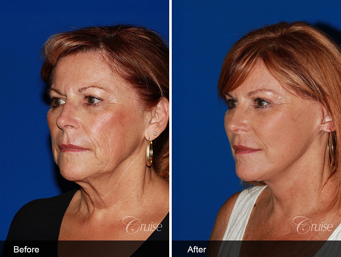 Face Lift Before & After