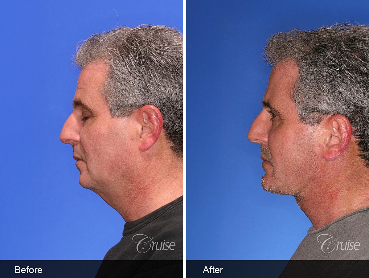 Face Lift Before & After