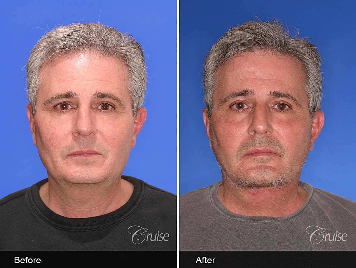 Face Lift Before & After