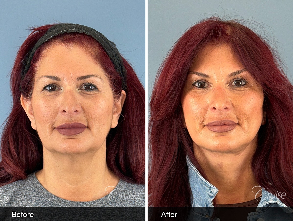 Female facelift and neck lift before and after at 3 weeks post-op in a 60-year-old woman, showing improved jawline definition and smoother neck contour in Southern California.