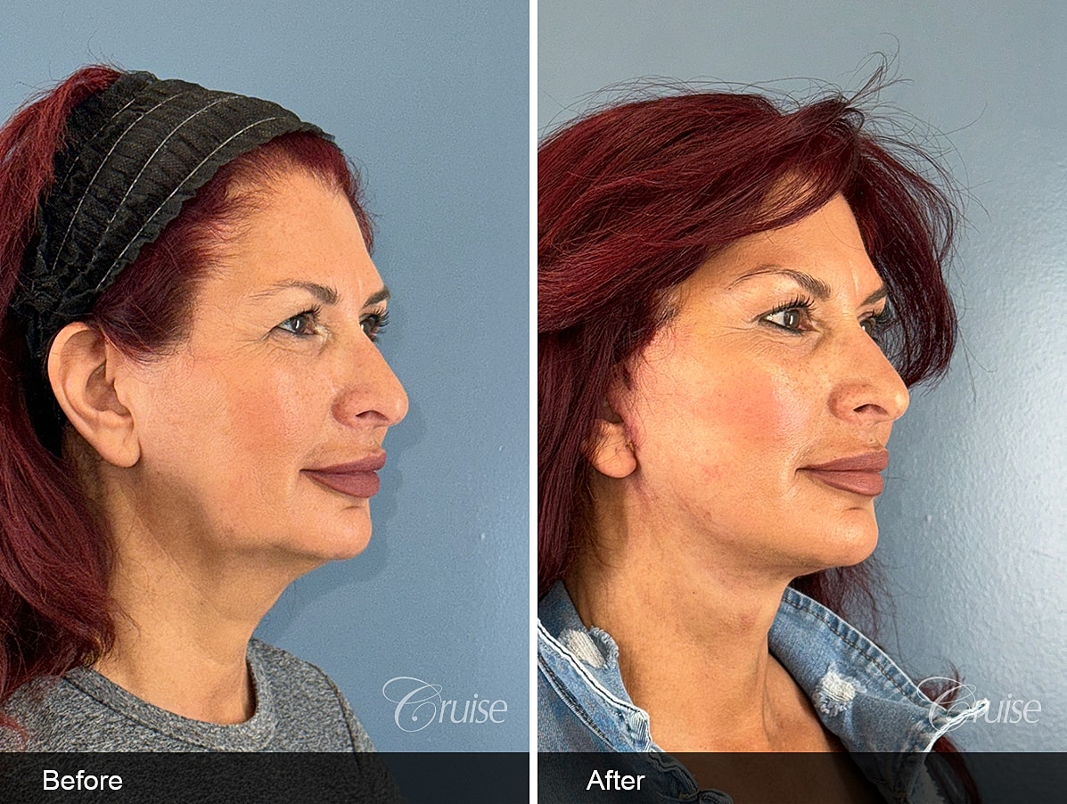 Female facelift and neck lift before and after at 3 weeks post-op in a 60-year-old woman, showing improved jawline definition and smoother neck contour in Southern California.