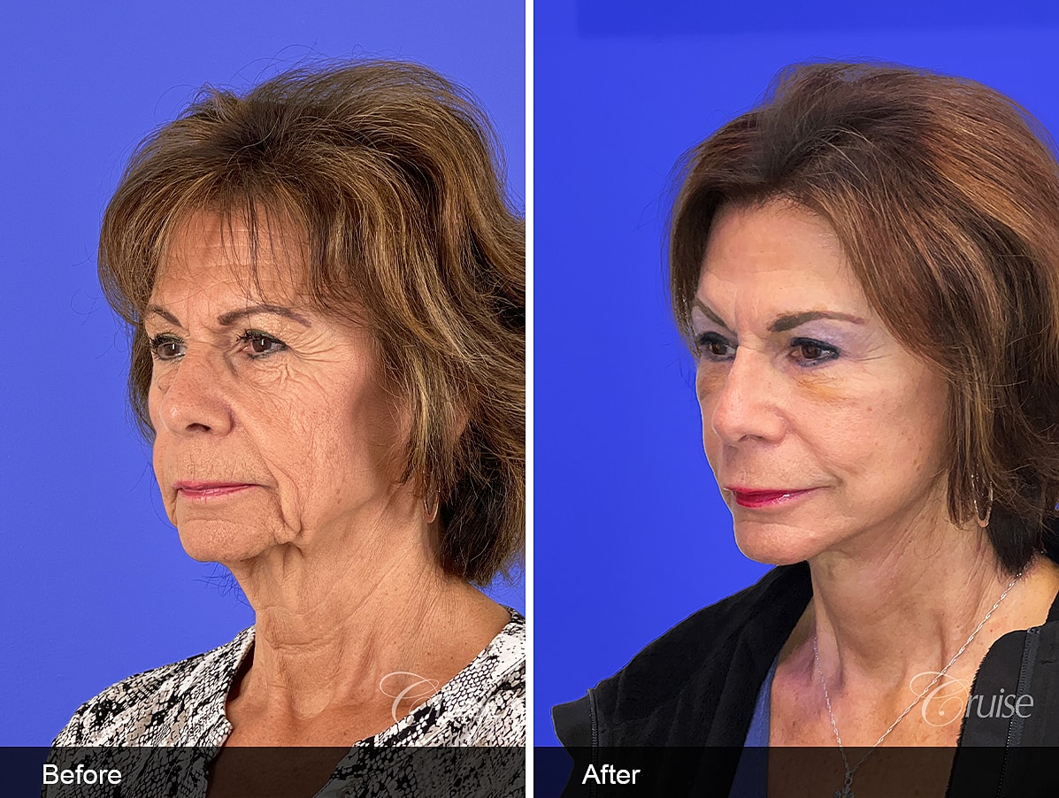 Face Lift Before & After
