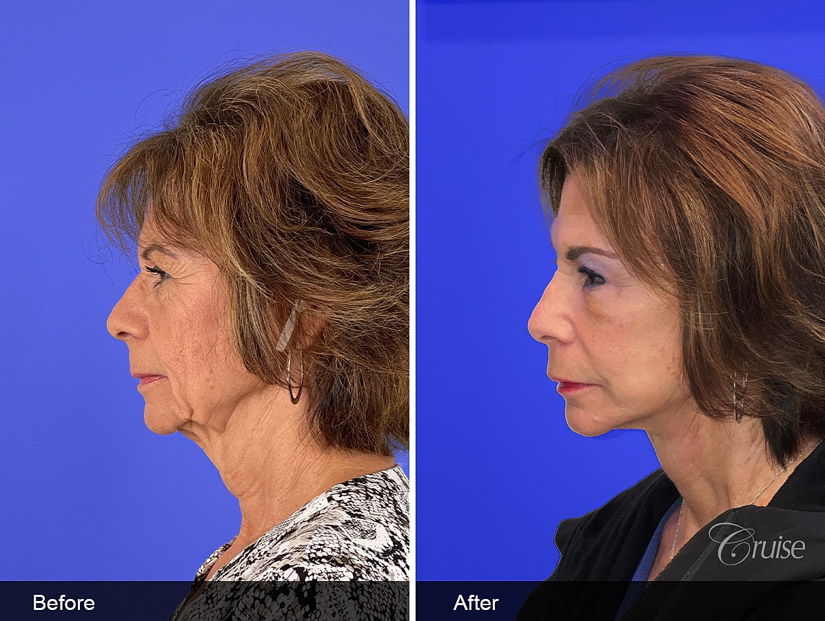 Face Lift Before & After