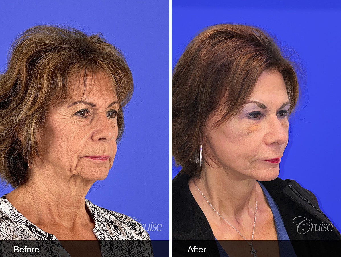 Face Lift Before & After