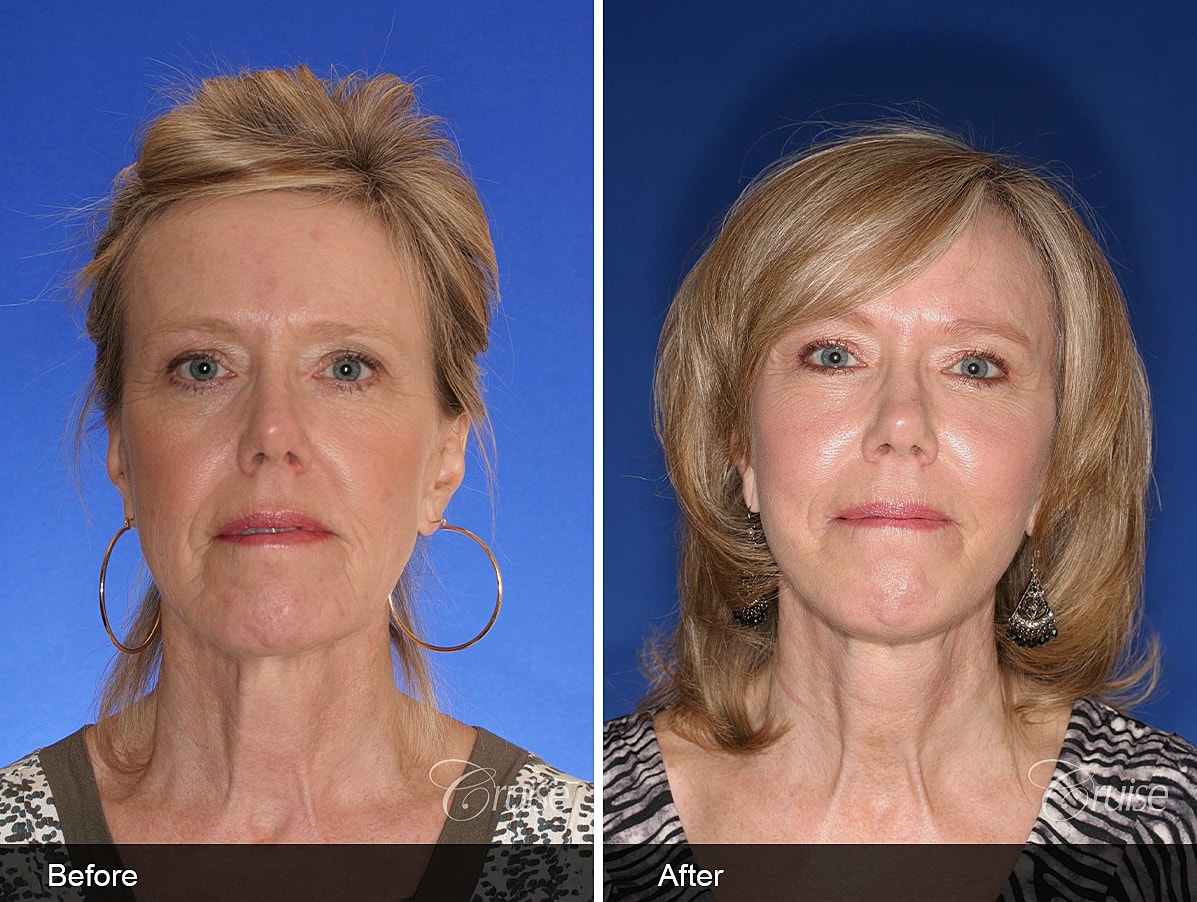 Face Lift Before & After