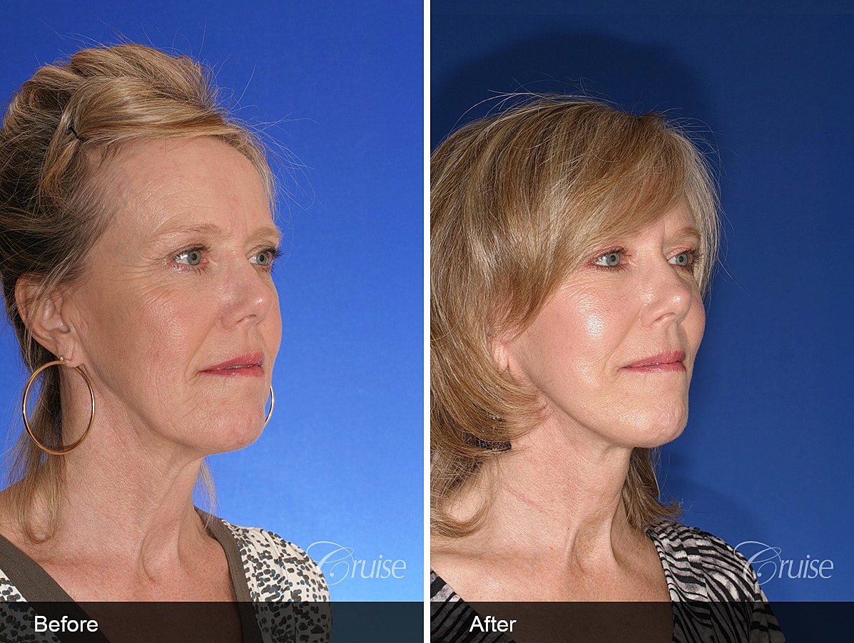 Face Lift Before & After