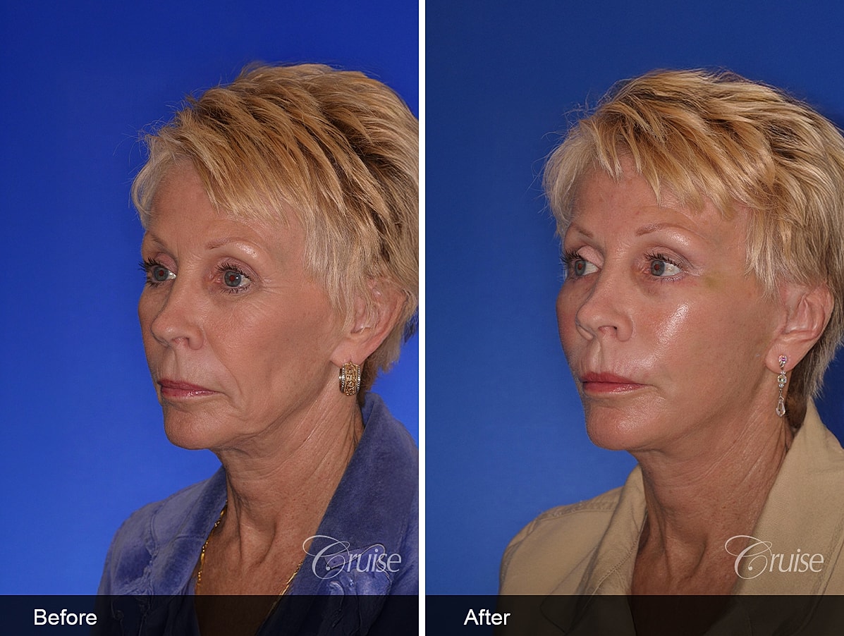 Face Lift Before & After