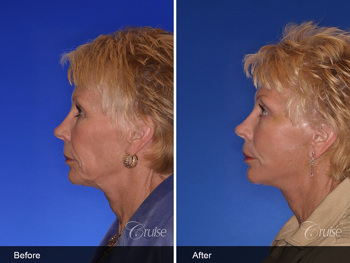 Face Lift Before & After