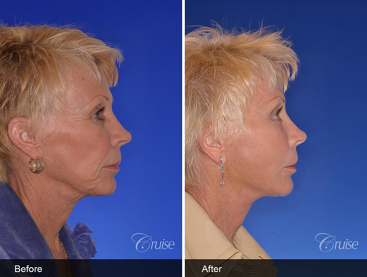 Face Lift Before & After