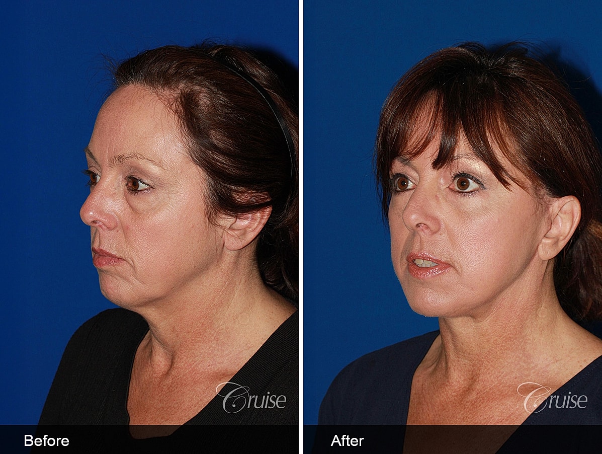 Face Lift Before & After
