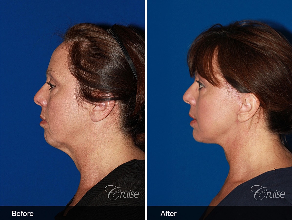 Face Lift Before & After