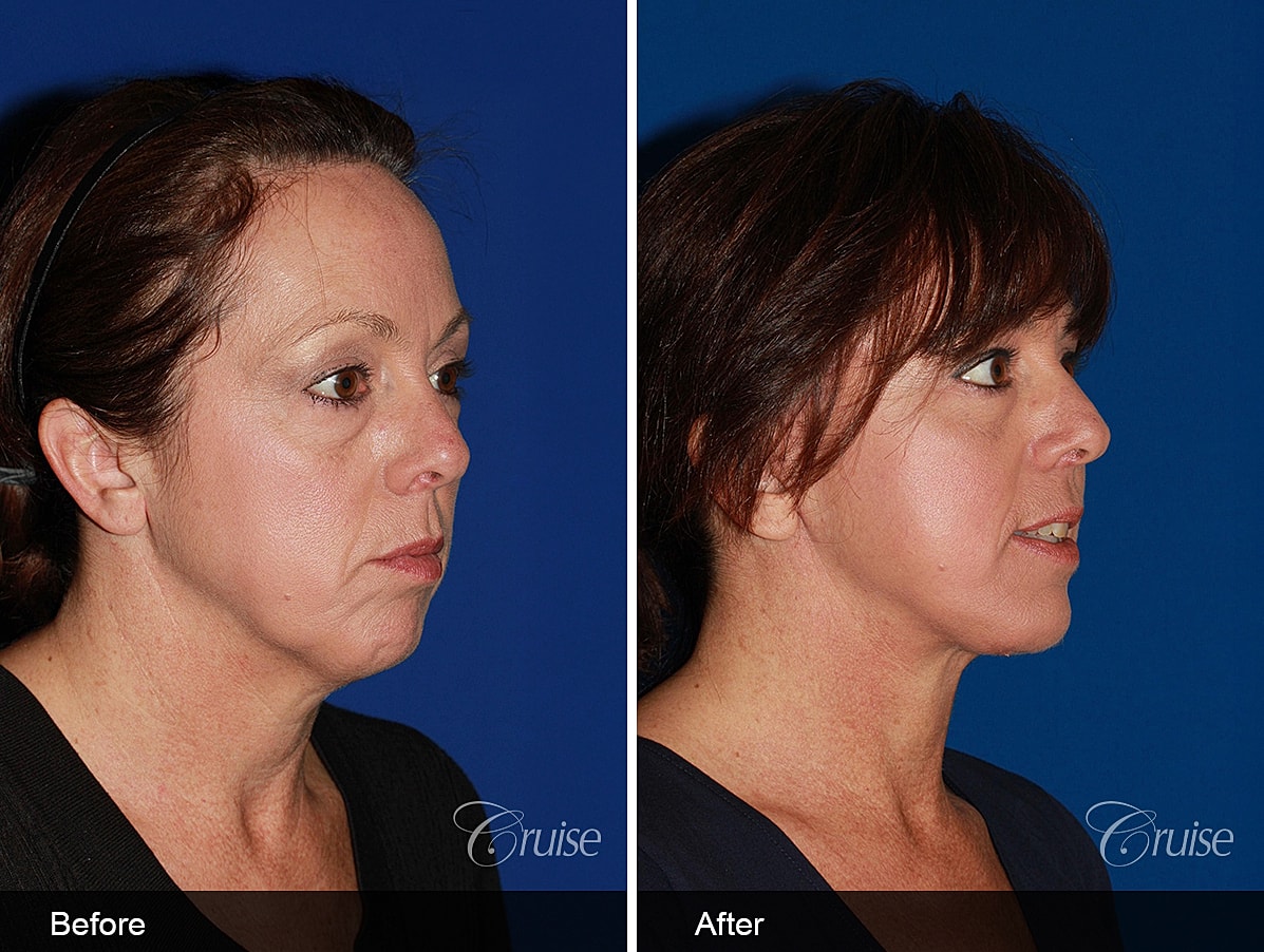 Face Lift Before & After