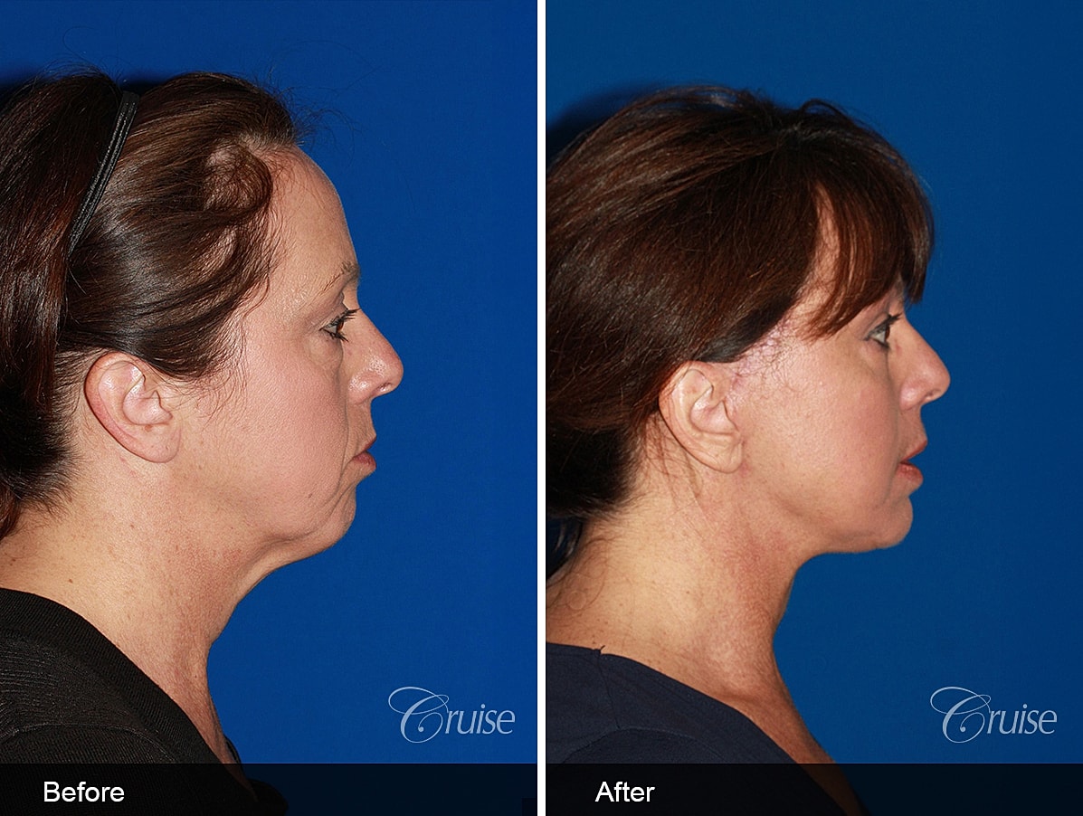 Face Lift Before & After
