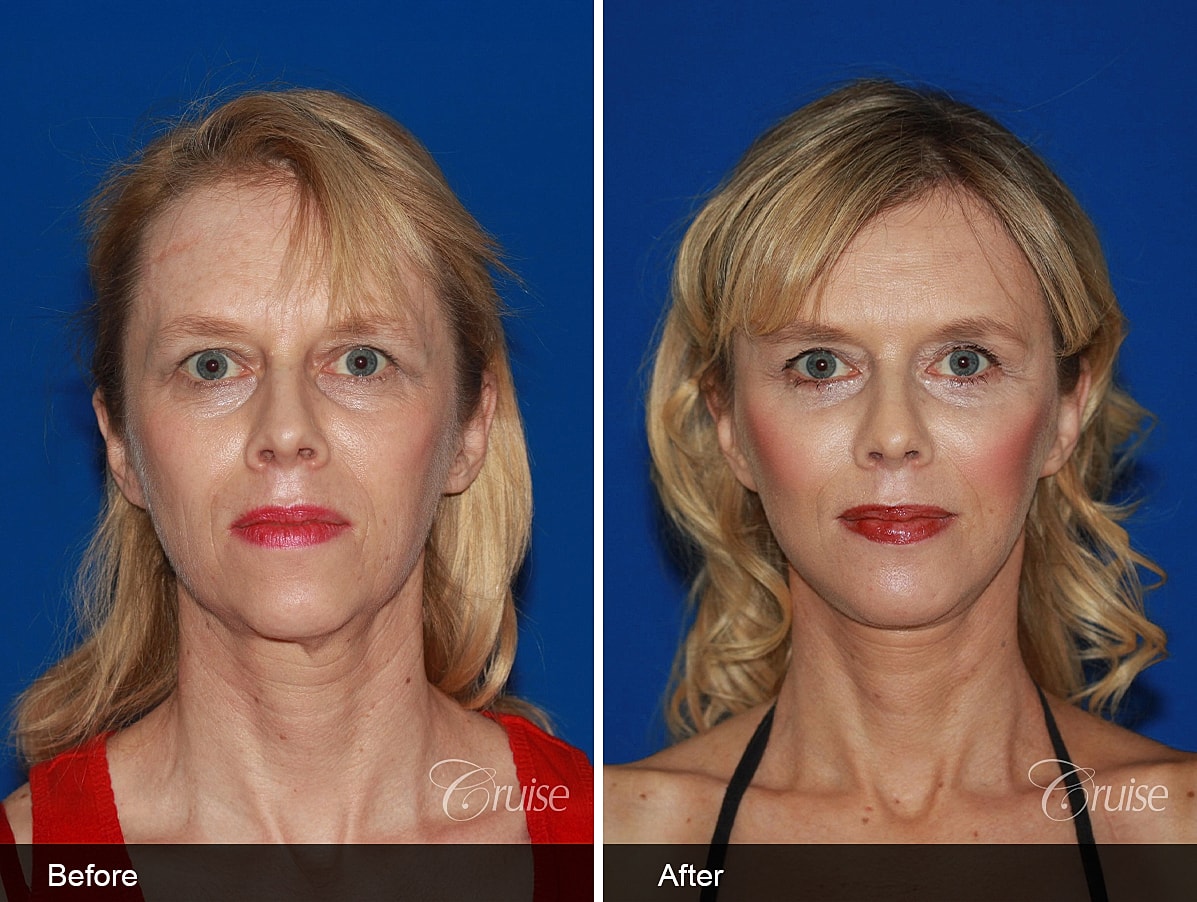 Face Lift Before & After