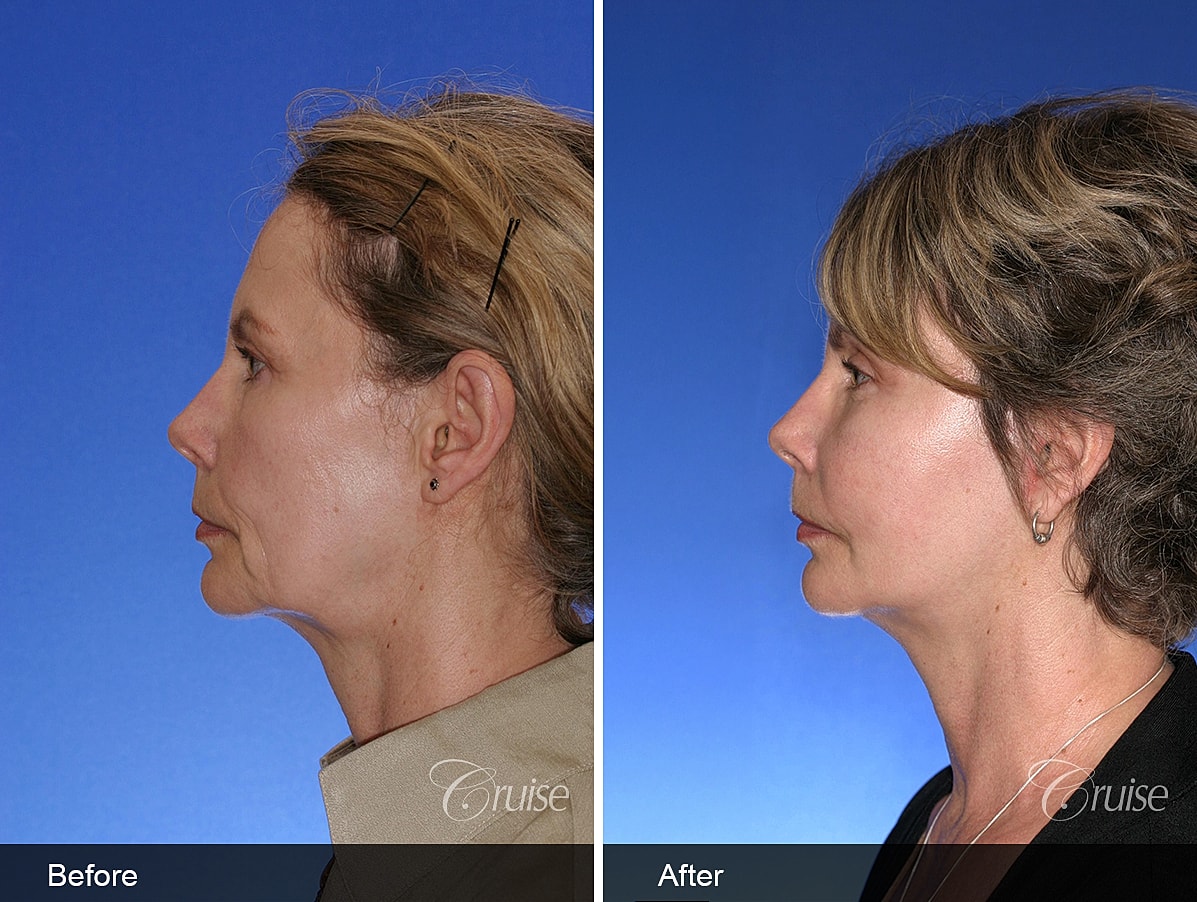 Face Lift Before & After