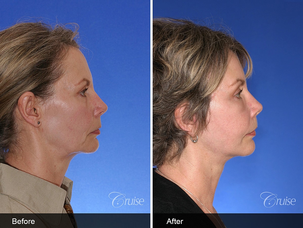 Face Lift Before & After