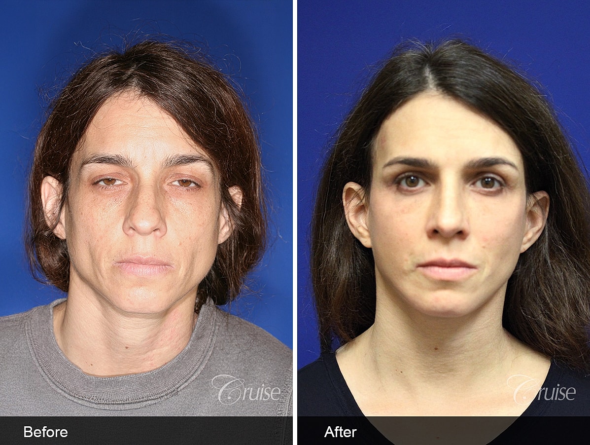 Face Lift Before & After