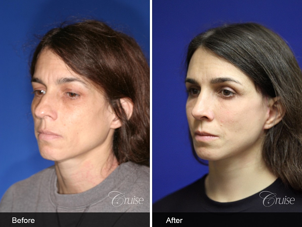 Face Lift Before & After