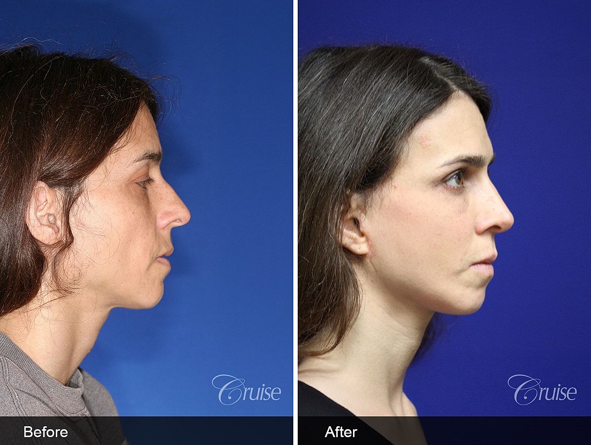 Face Lift Before & After