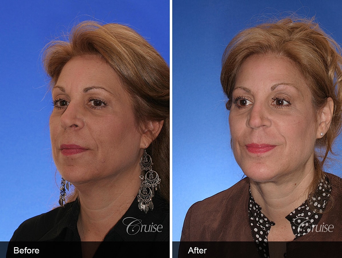 Face Lift Before & After