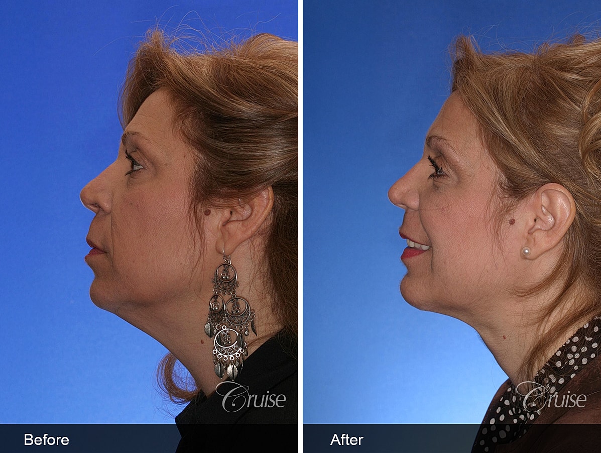 Face Lift Before & After