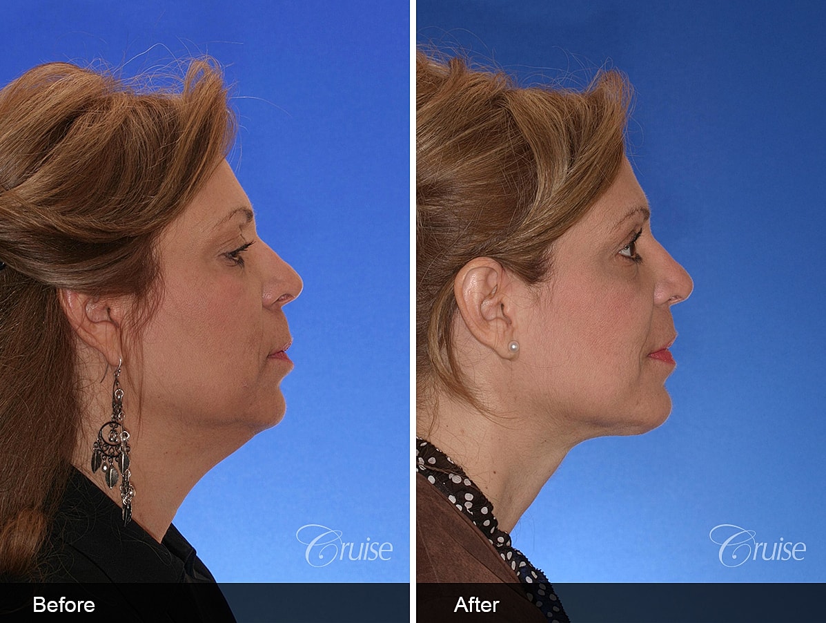 Face Lift Before & After
