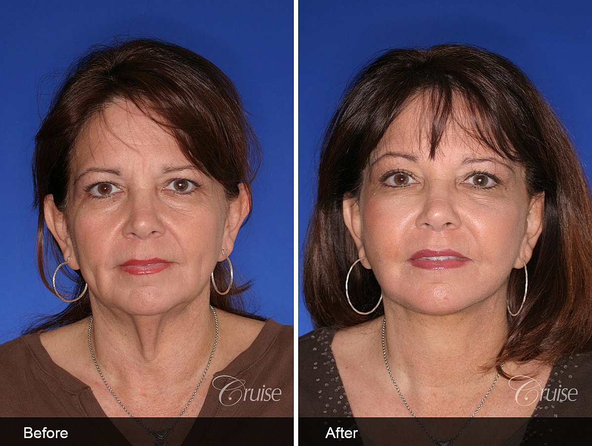 Face Lift Before & After