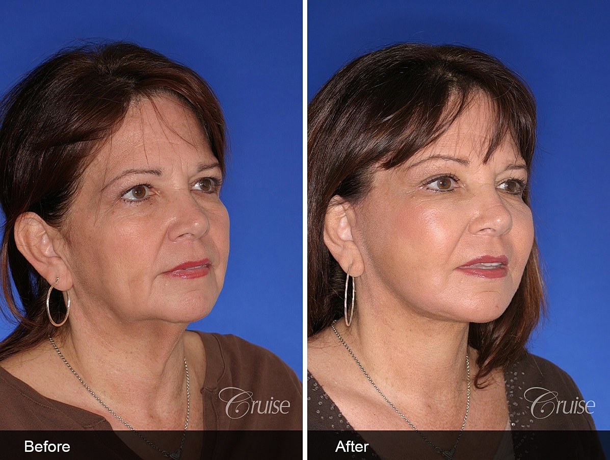 Face Lift Before & After