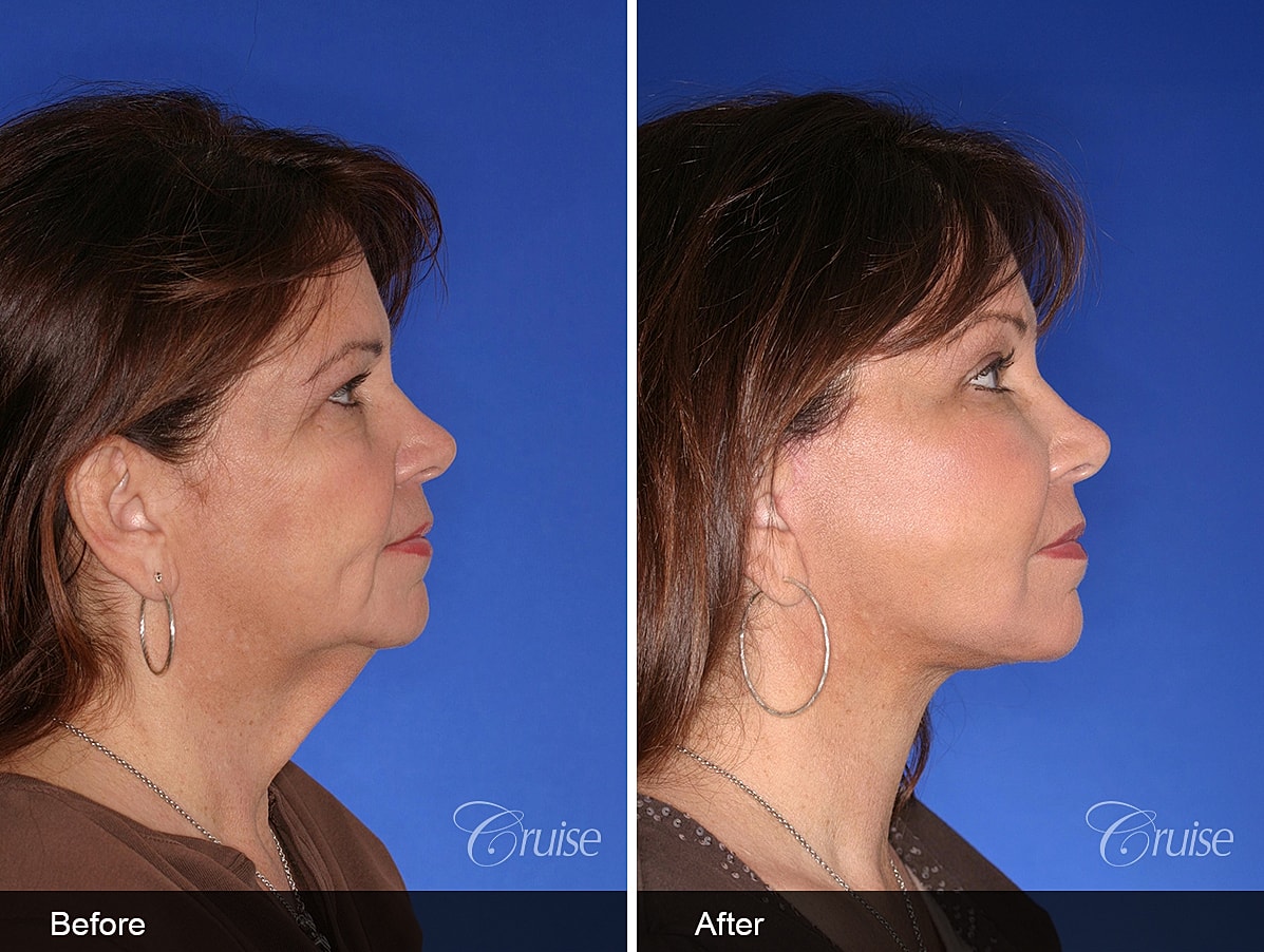 Face Lift Before & After