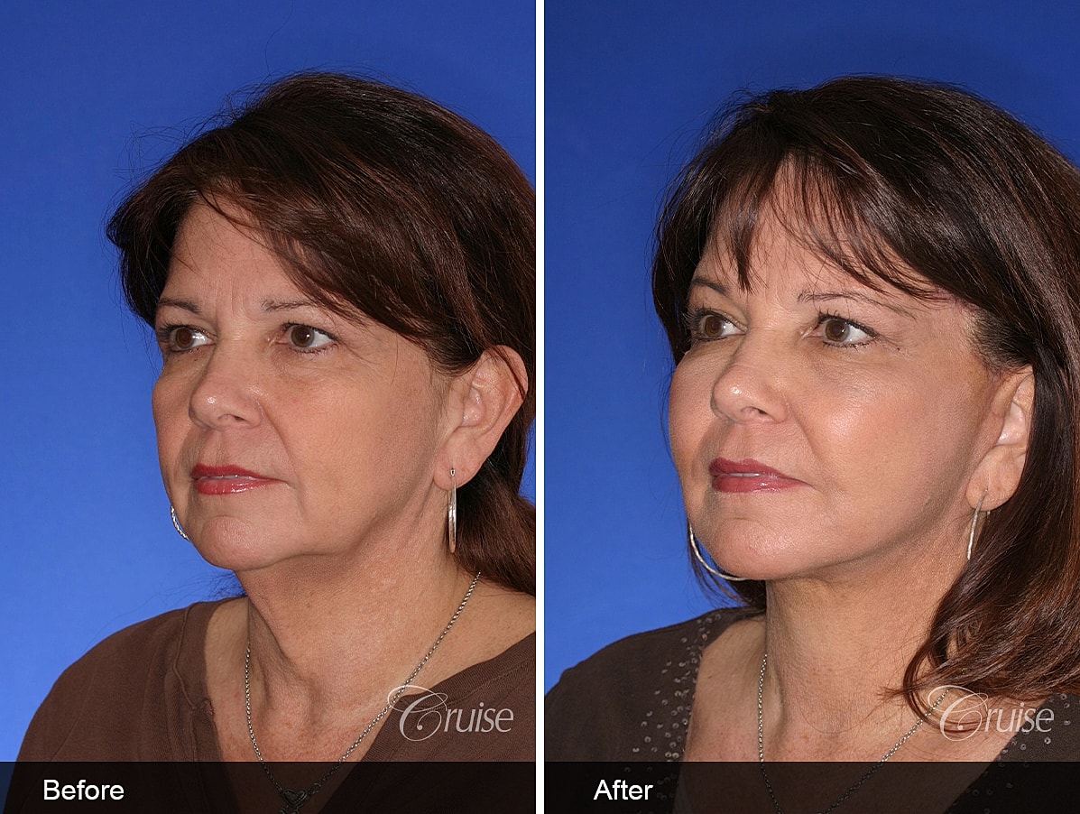 Face Lift Before & After
