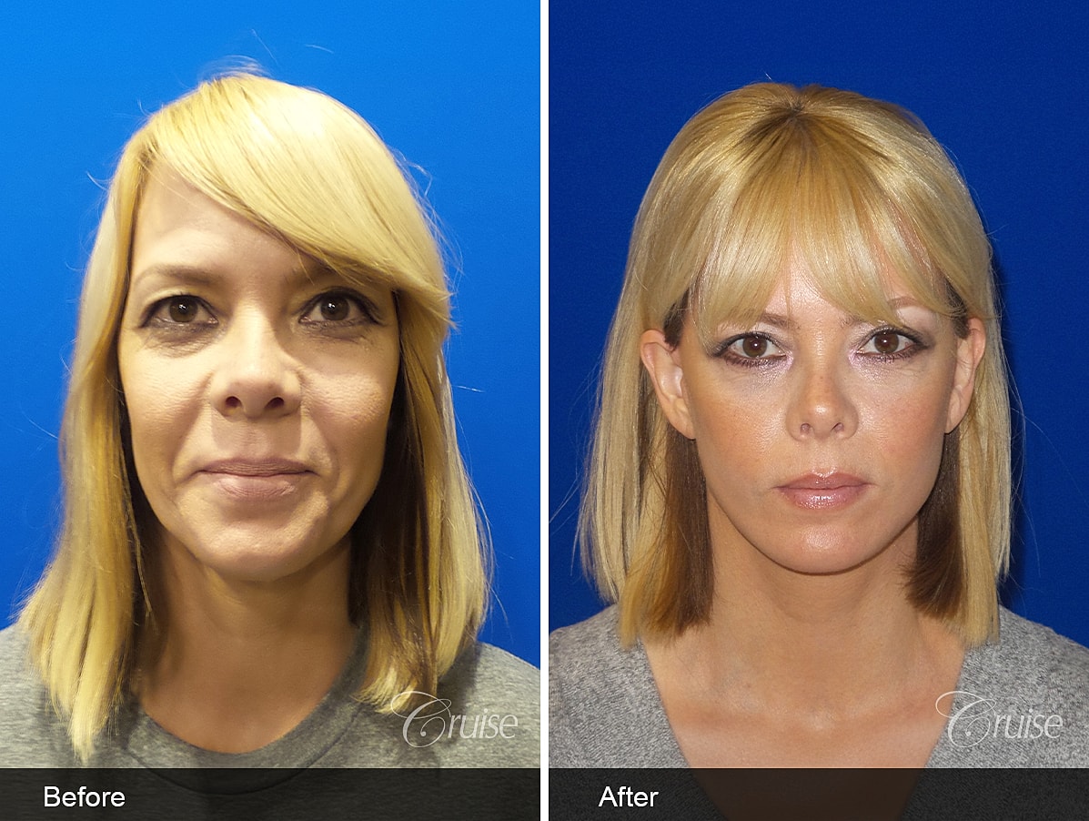 Face Lift Before & After