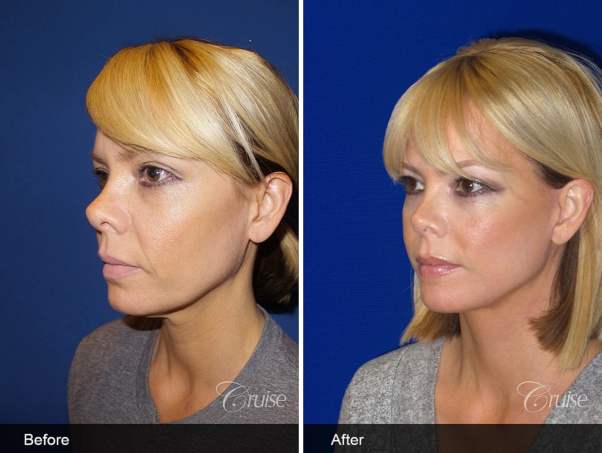 Face Lift Before & After
