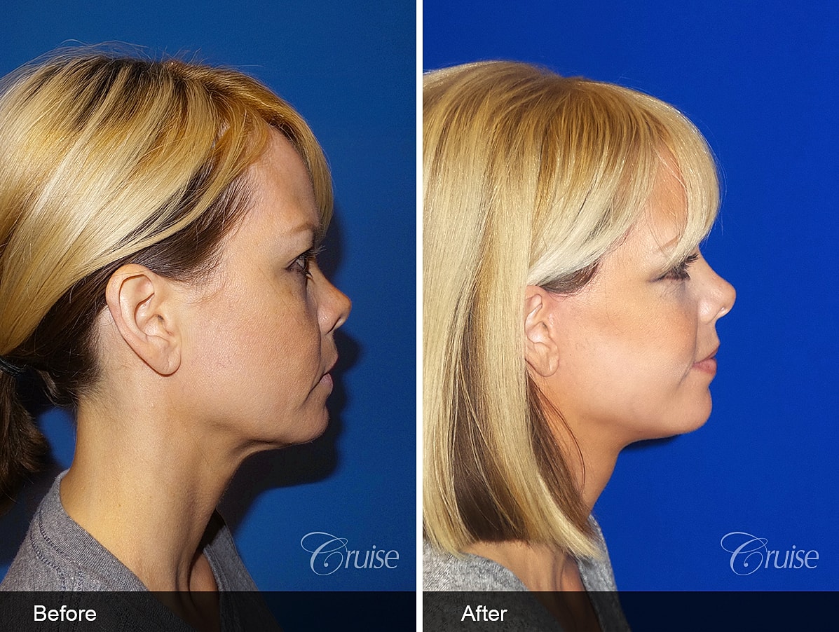 Face Lift Before & After