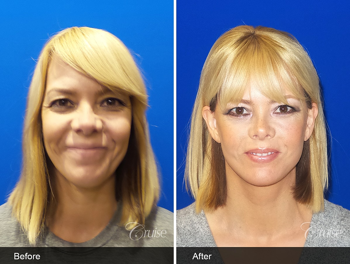 Face Lift Before & After