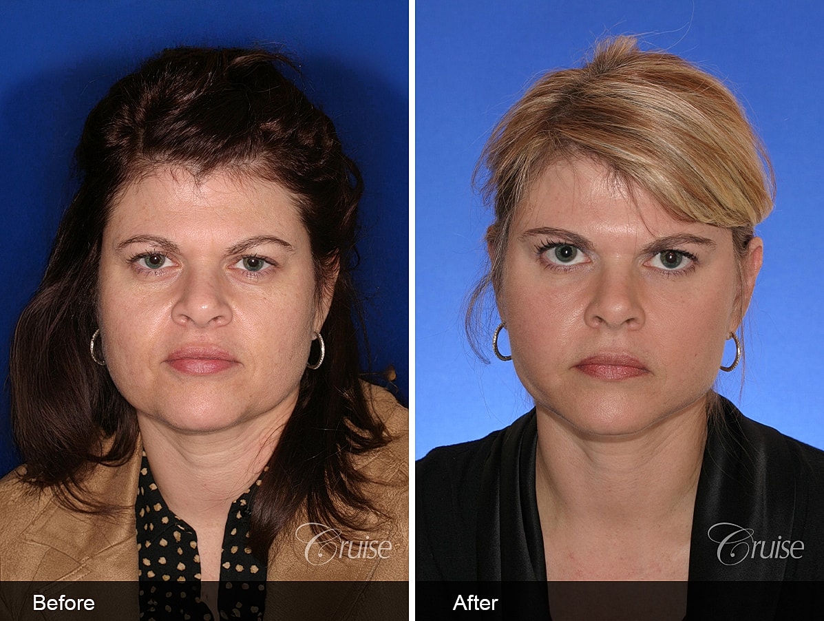 Face Lift Before & After