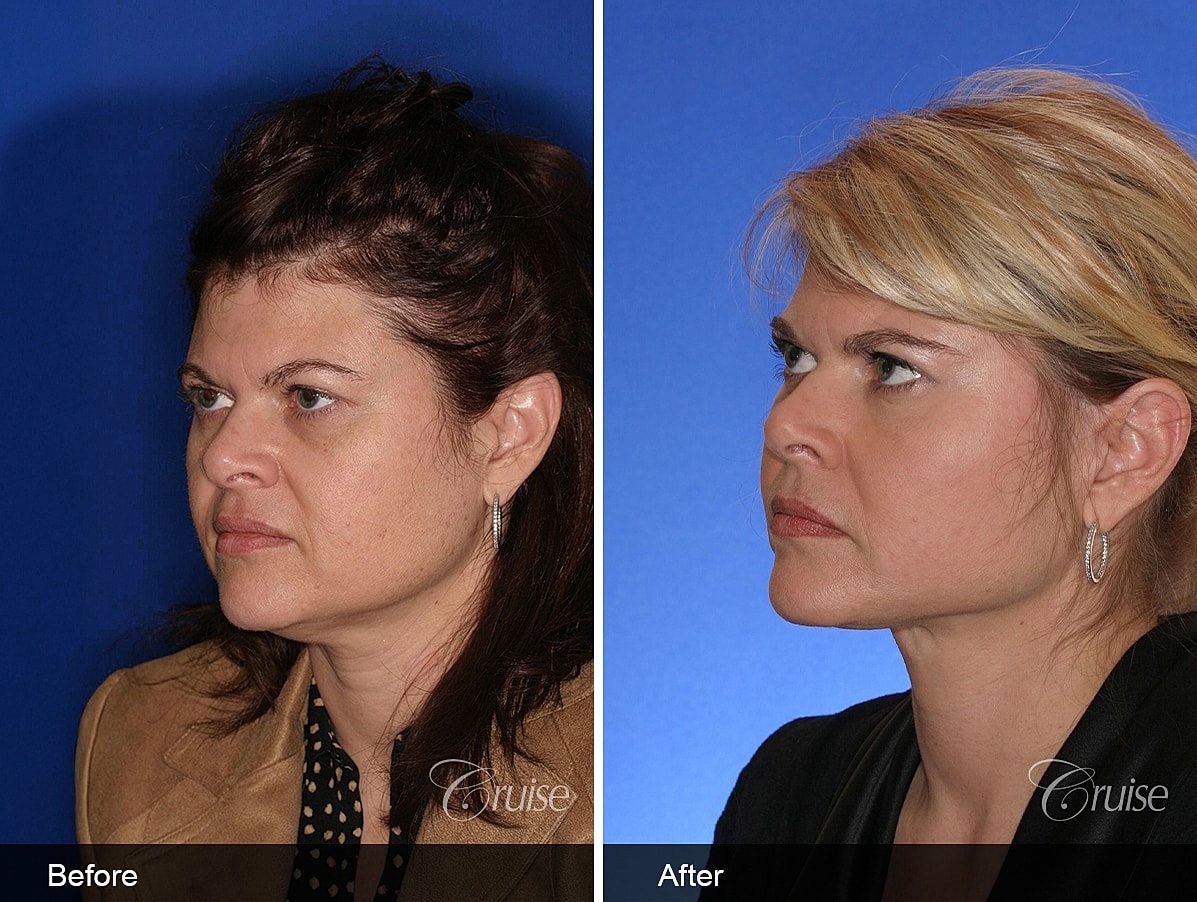 Face Lift Before & After