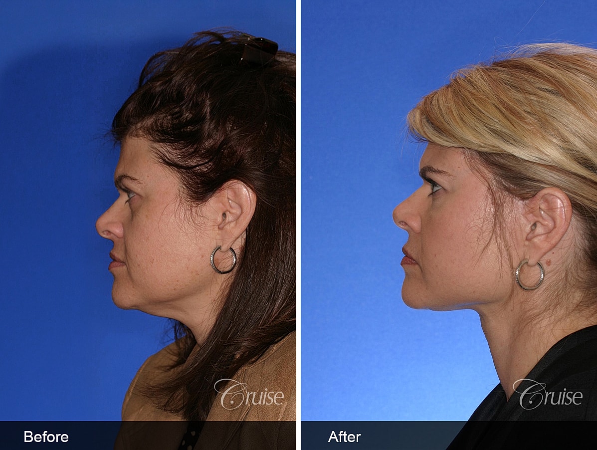 Face Lift Before & After