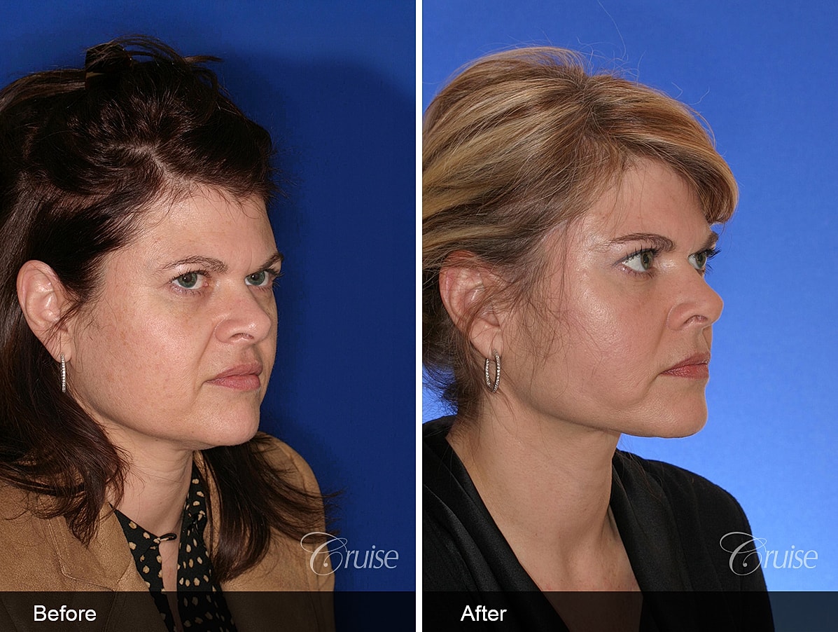 Face Lift Before & After