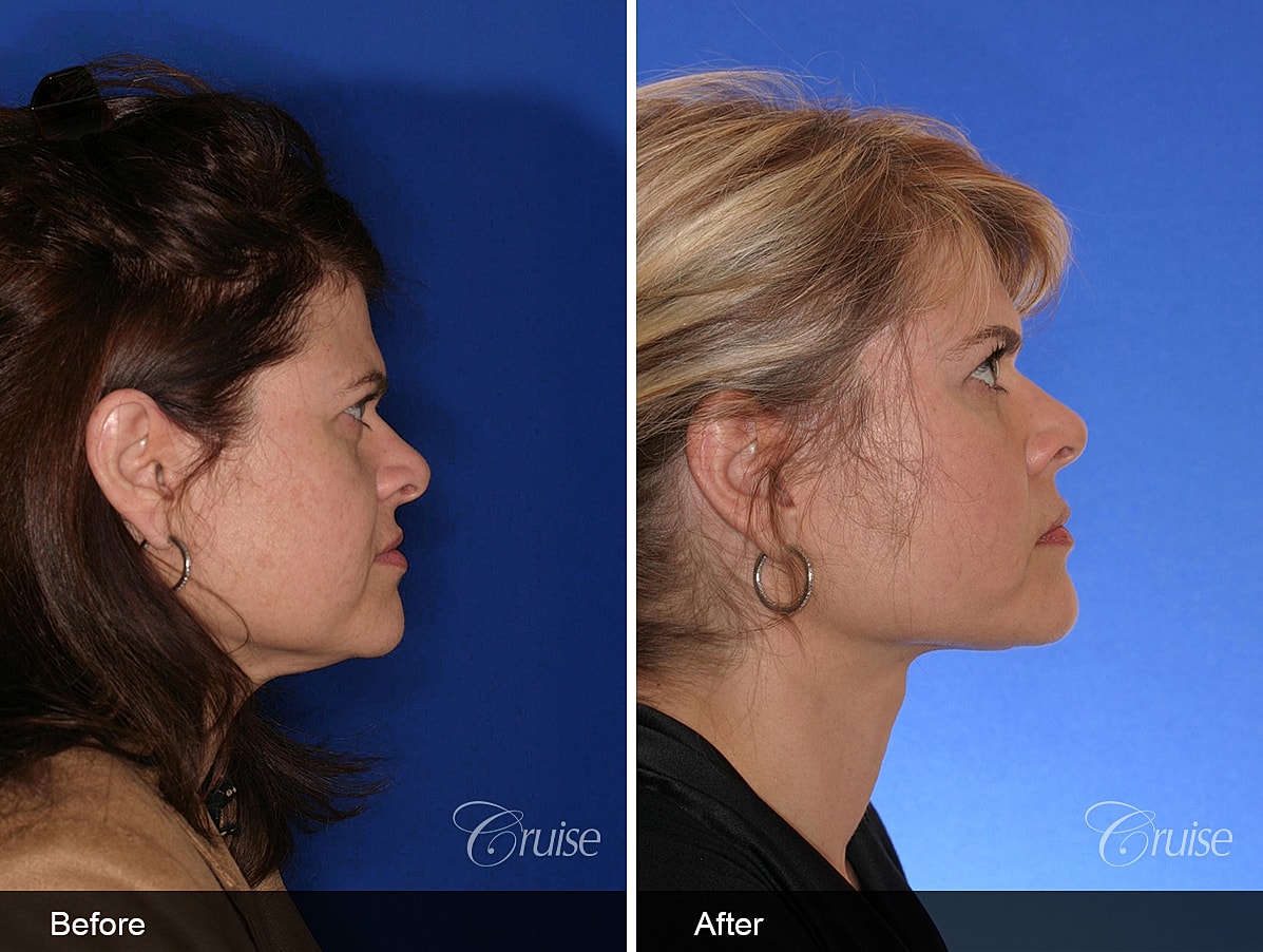 Face Lift Before & After