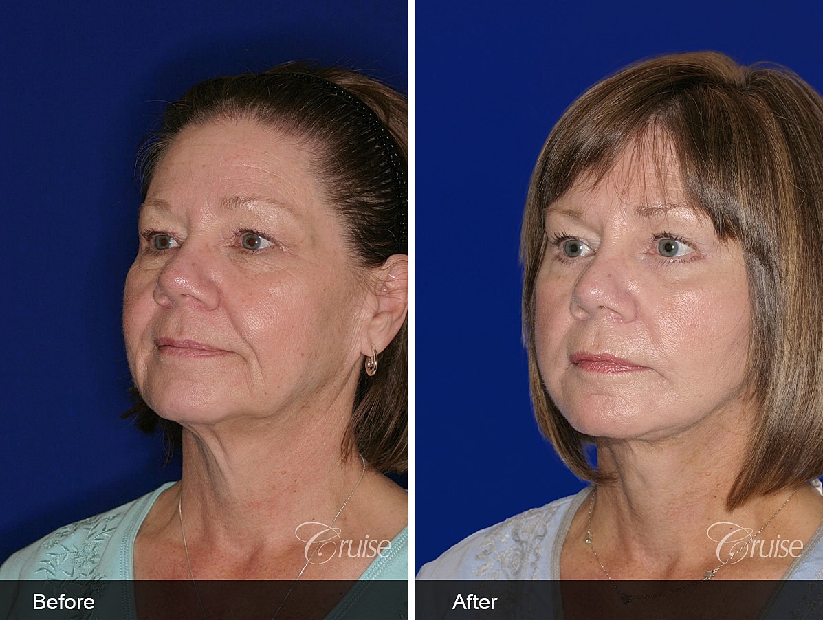 Face Lift Before & After