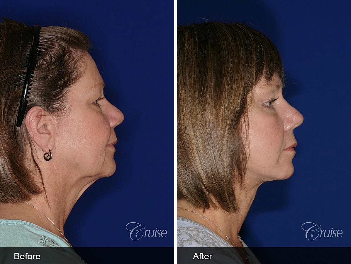 Face Lift Before & After