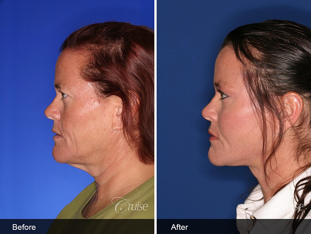 Face Lift Before & After